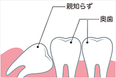 親知らずの抜歯