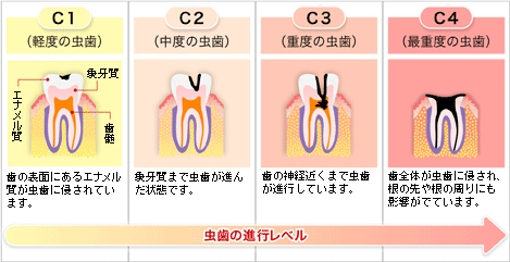 虫歯の進行レベル