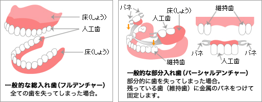 一般的な総入れ歯と部分入れ歯について